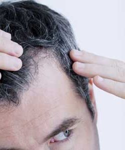 Die Haartransplantation (mit der FUE Technik)